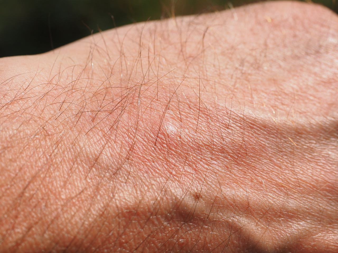 Mosquito Bite – Now what?